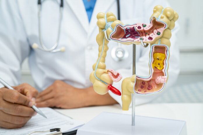 Anestheticly focused classroom scene with a doctor’s hands writing beside a large anatomical model of the colon on a stand, showing sections and polyps, for medical education.