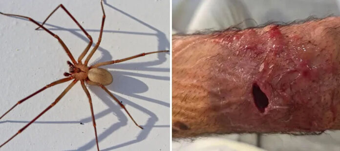 Split image: left shows a brown long-legged spider on a white surface; right shows a forearm with a deep bleeding wound and scrapes.